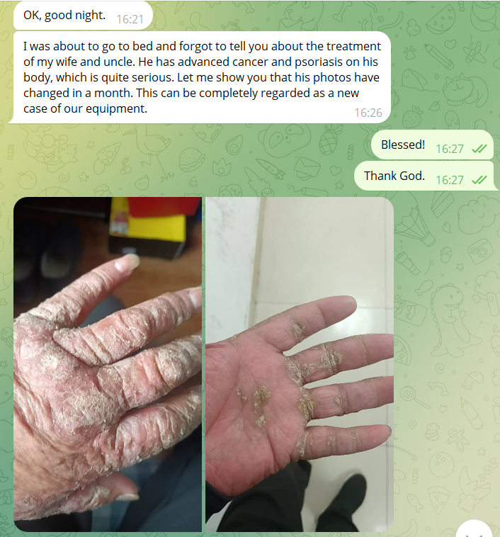 Psoriasis before MWO