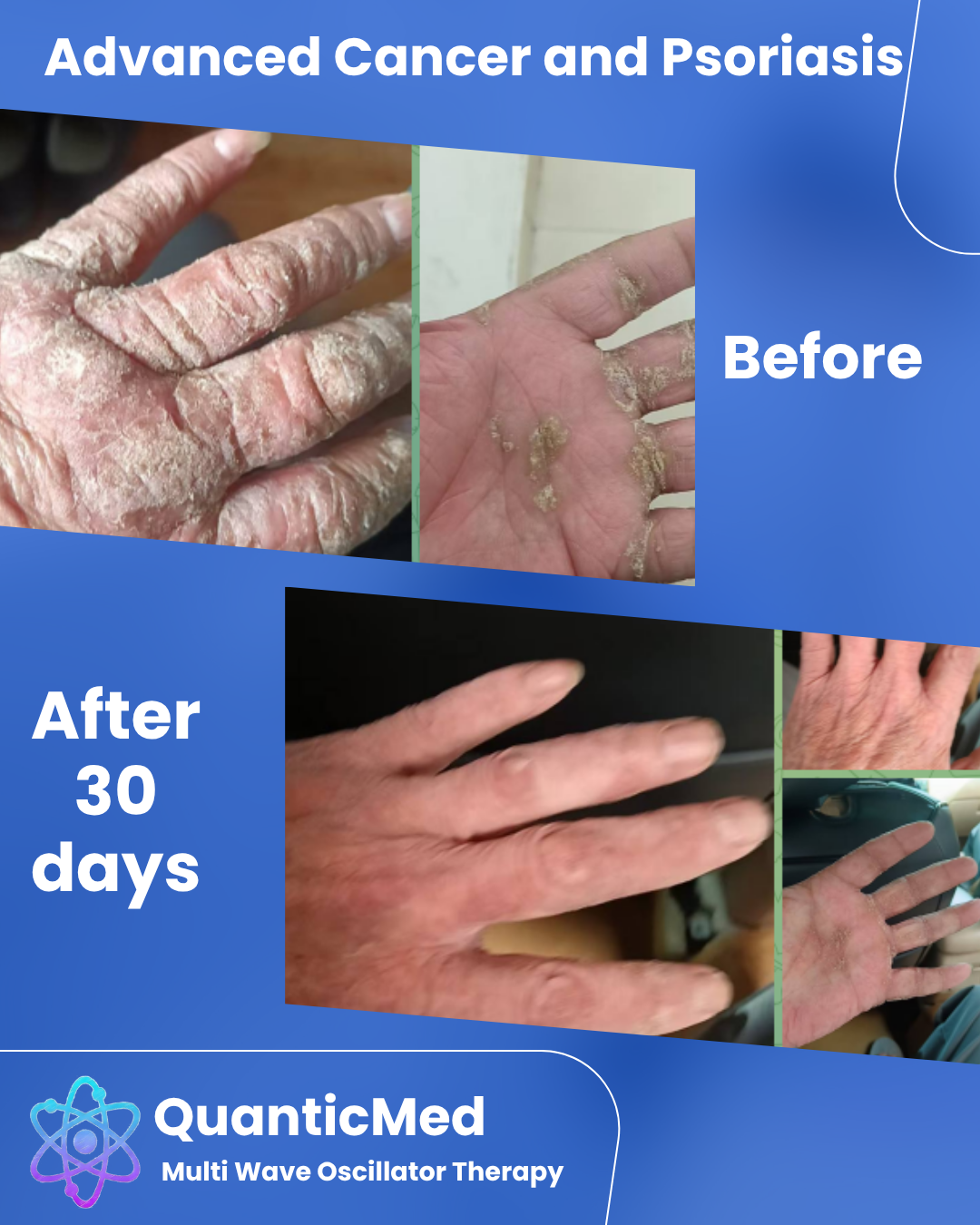 Psoriasis progress with MWO